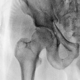 Osteoporosis & Men