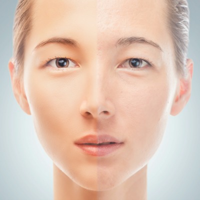 Diet Change = Clear Complexion