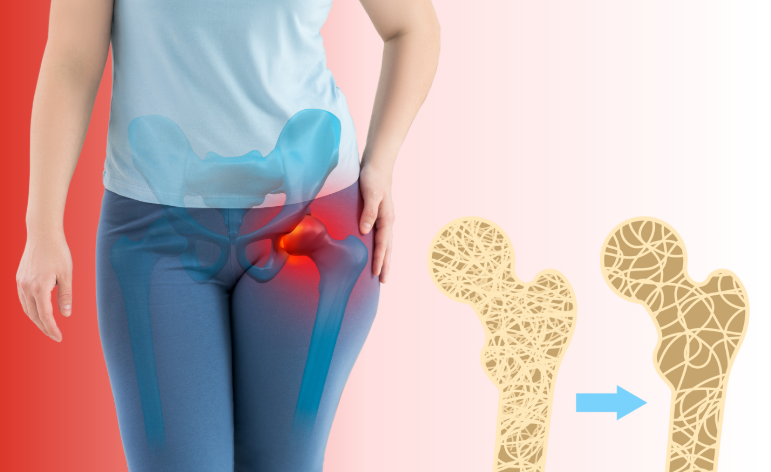 The Bone Truth: Osteoporosis and Women