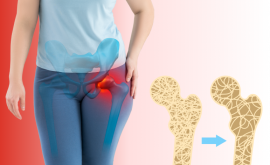 The Bone Truth: Osteoporosis and Women