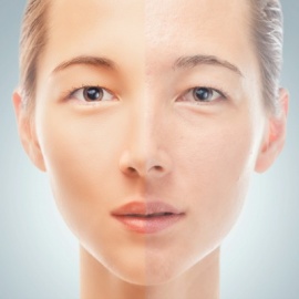 Diet Change = Clear Complexion